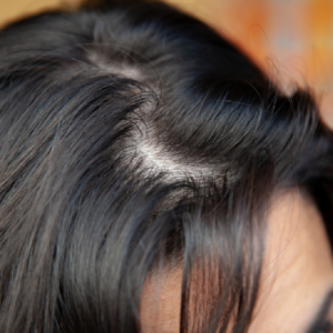 comment se débarasser des cheveux gras